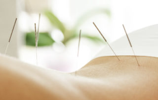 Acupuncture Treatment in Houston