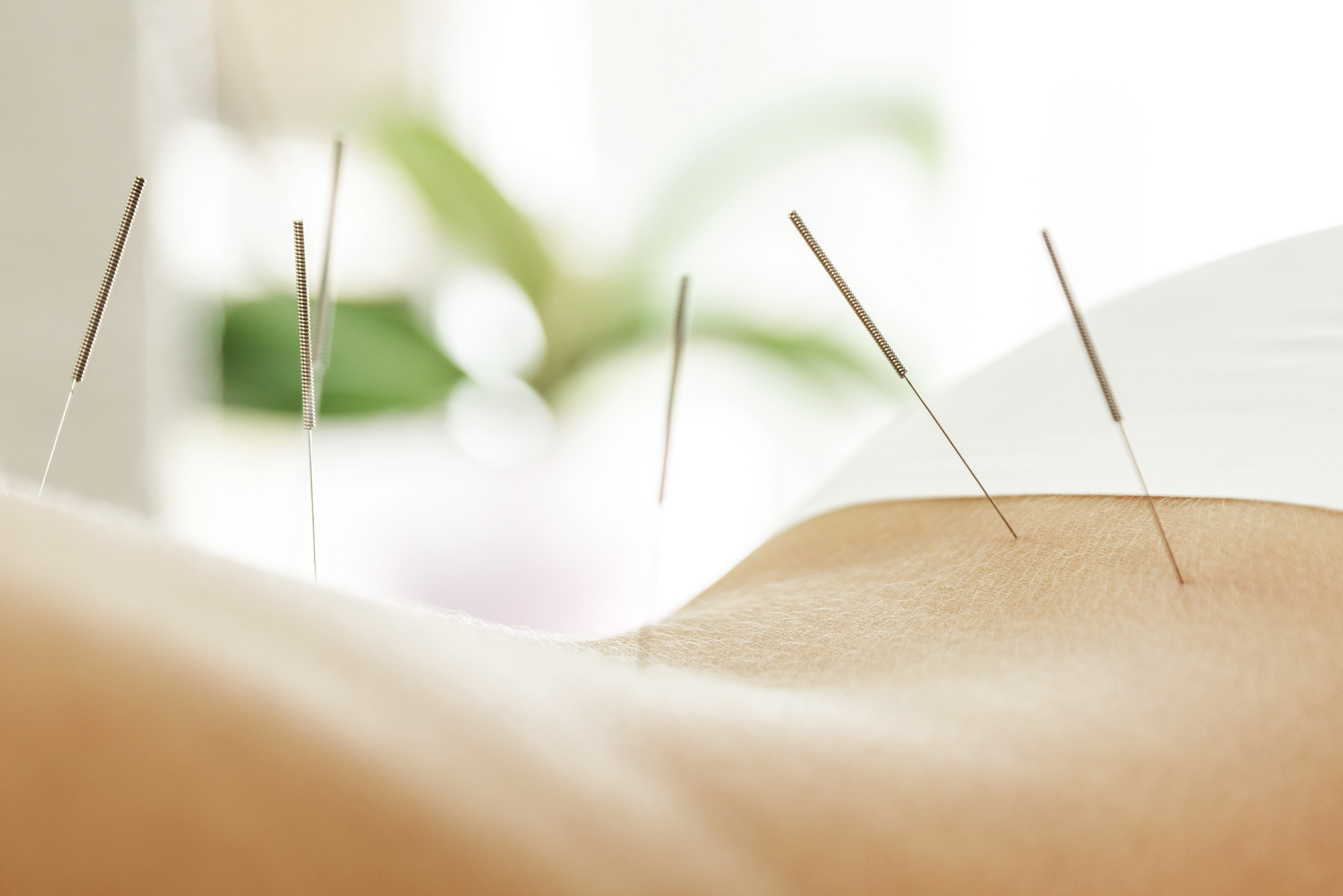 Acupuncture Treatment in Houston