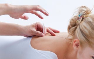 Acupuncture Treatment in Houston