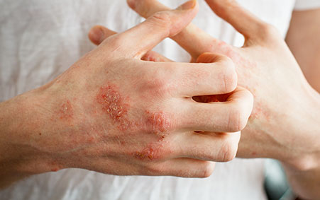 Houston-weMED-Skin-DisordersTreatment-Eczema