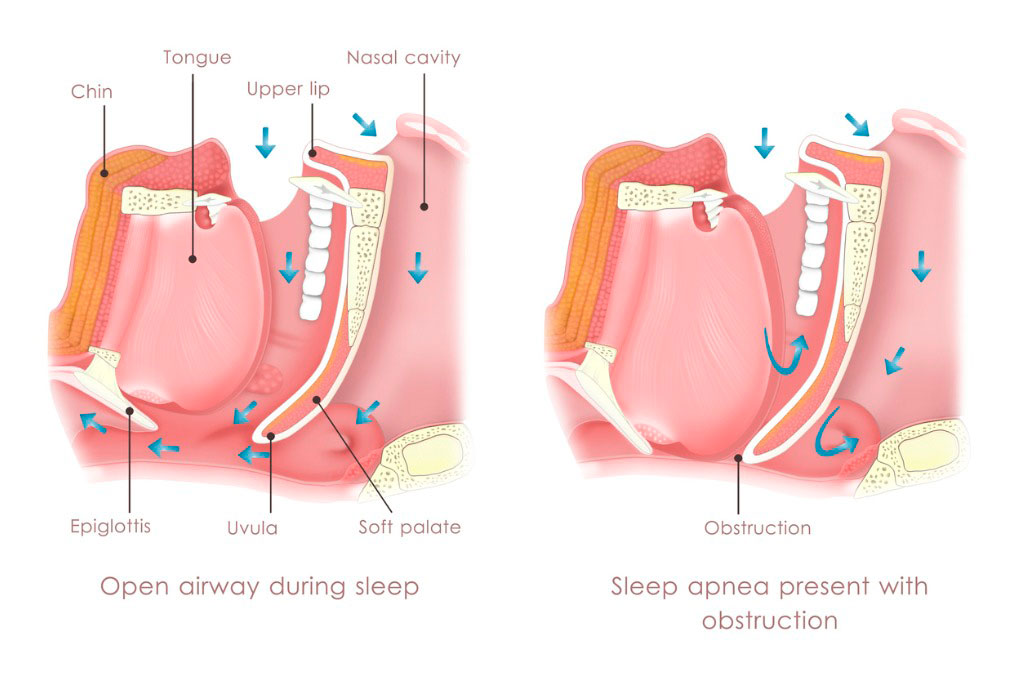 obstruction-sleep-apnea-picture-id155021599