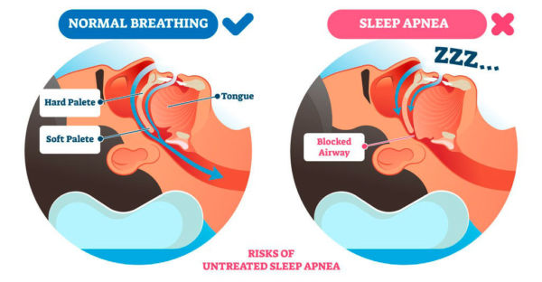 Snoring and Sneap Program Treatment - weMED Health