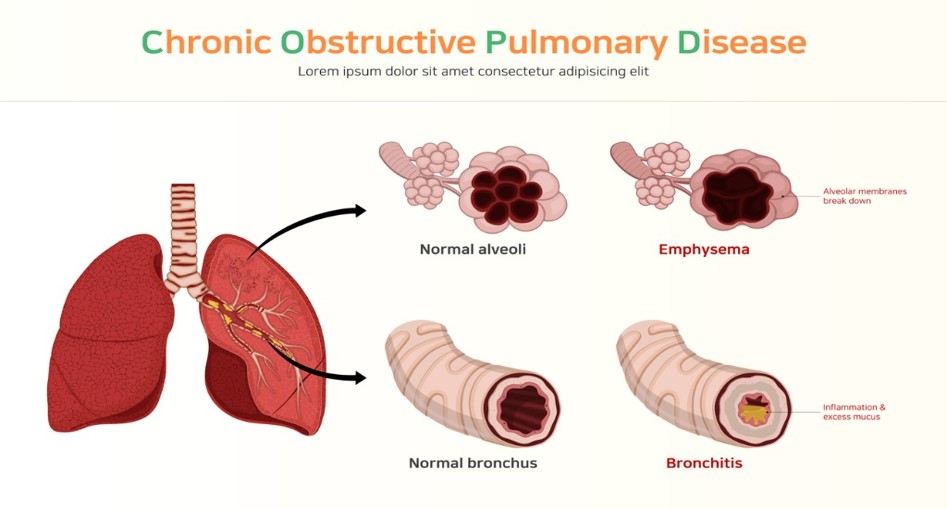 houston wemed chronic obstructive pulmonary disease