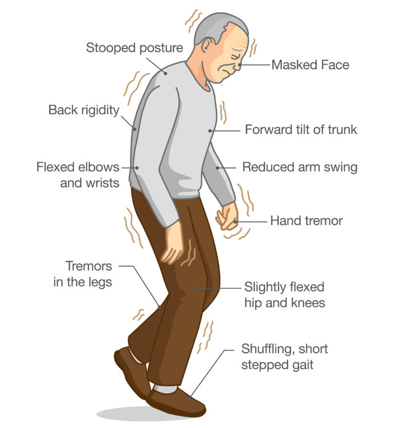 weMEDClinics, Treatment Parkinson Symptom, Tremors Legs, 2400 FM 1488 #300, The Woodlands, TX 77384